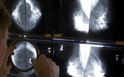 Cancer du sein | Pas de dépistage systématique pour les 45 à 49 ans malgré une recommandation de l’INESSS